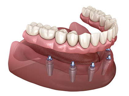 Illustration of permanent denture implants