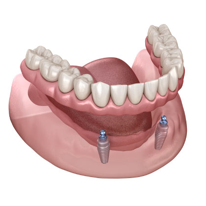 Illustration of denture implants