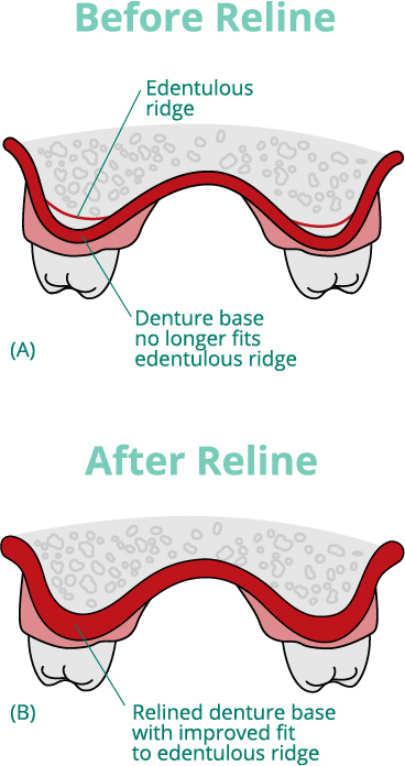 Before and after illustration of relined dentures